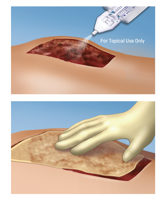 Two images - one showing the application of Artiss and the other showing the graft application by hand