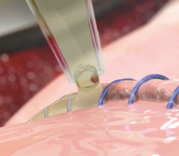 Image of Preveleak being applied to the suture line